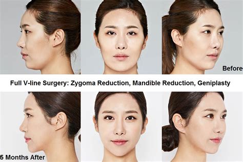 lv plastic surgery seoul|best facelift in korea.